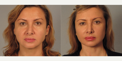 Facelift before and after photo
