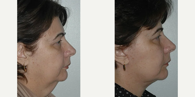 Facelift before and after photo