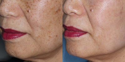Laser Resurfacing before and after photo