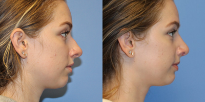 Rhinoplasty before and after photo