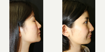 Asian Rhinoplasty before and after photo