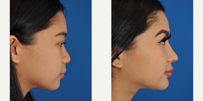 Chin Implant before and after photo