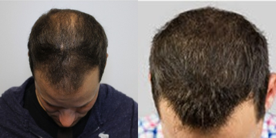 FUE Hair Transplant before and after photo