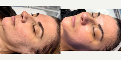 HydraFacial before and after photo