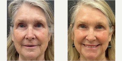 Laser Resurfacing before and after photo
