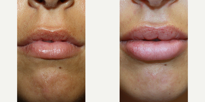 Neck Lift before and after photo