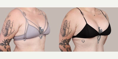 Breast Augmentation before and after photo