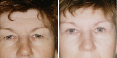 Brow Lift before and after photo