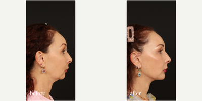 Chin Implant before and after photo