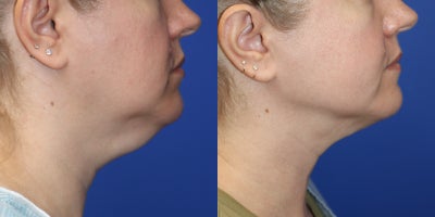 Chin Liposuction before and after photo