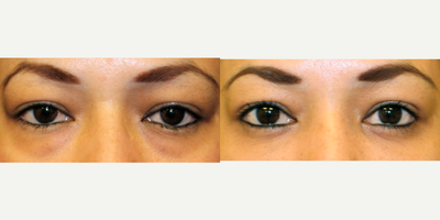 Eyelid Surgery before and after photo