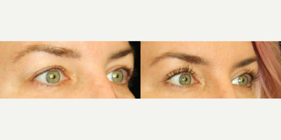 Eyelid Surgery before and after photo
