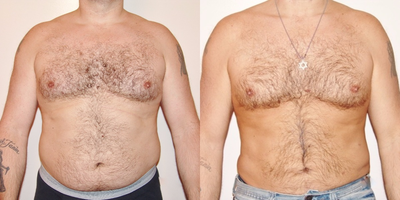 Liposuction before and after photo