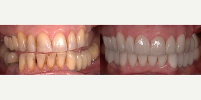 Smile Makeover before and after photo