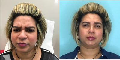 Botox before and after photo