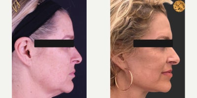 Deep Plane Facelift before and after photo