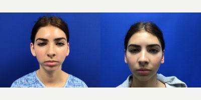 Ear Surgery before and after photo