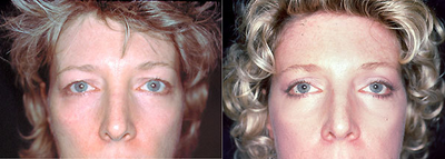 Eyelid Surgery before and after photo