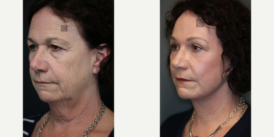 before and after image