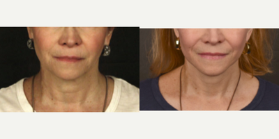 Brow Lift before and after photo