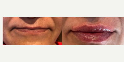 Dermal Fillers before and after photo
