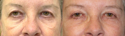 Eyelid Surgery before and after photo