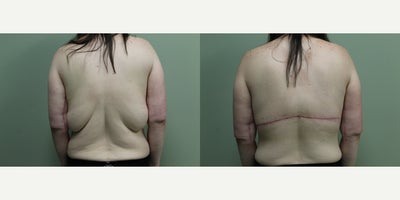 Body Lift before and after photo