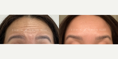 Botox before and after photo