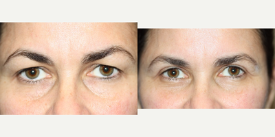 Eyelid Surgery before and after photo