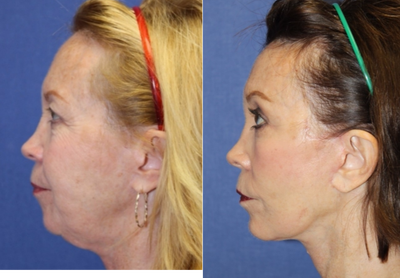 Facelift before and after photo