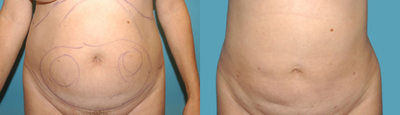 Liposuction before and after photo