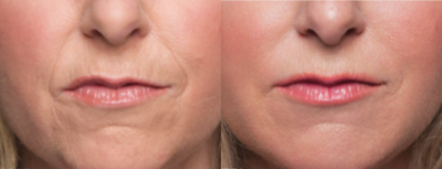Radiesse before and after photo