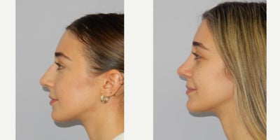 Rhinoplasty before and after photo