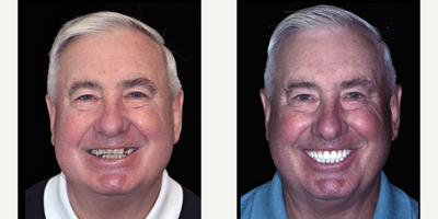 All-on-4 Dental Implants before and after photo