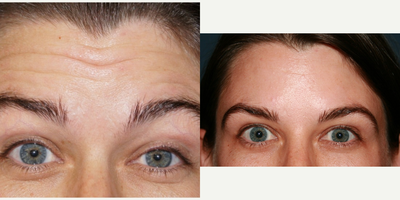 Botox before and after photo