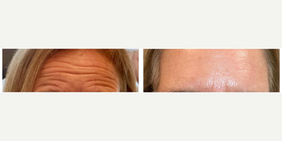 Dysport before and after photo