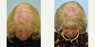 Hair Transplant before and after photo