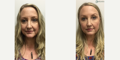 Liquid Facelift before and after photo