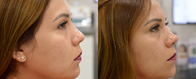 Nonsurgical Nose Job before and after photo