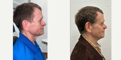 Rhinoplasty before and after photo