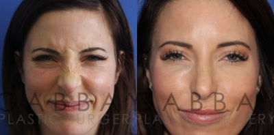 Botox before and after photo