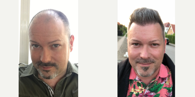 Hair Transplant before and after photo