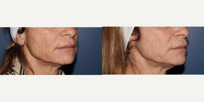 Halo Laser before and after photo