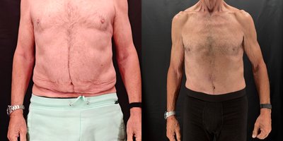 Lipo 360 before and after photo