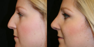 Rhinoplasty before and after photo