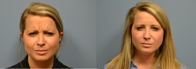 Botox before and after photo