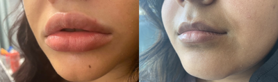 Dermal Fillers before and after photo