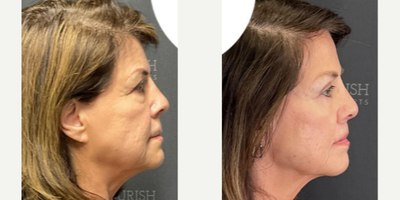 Eyelid Surgery before and after photo