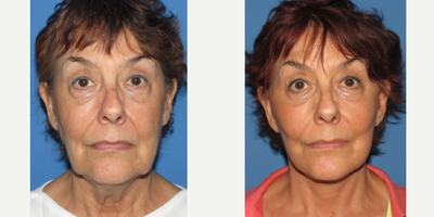 Facelift before and after photo