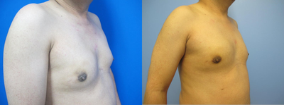 Gynecomastia Surgery before and after photo